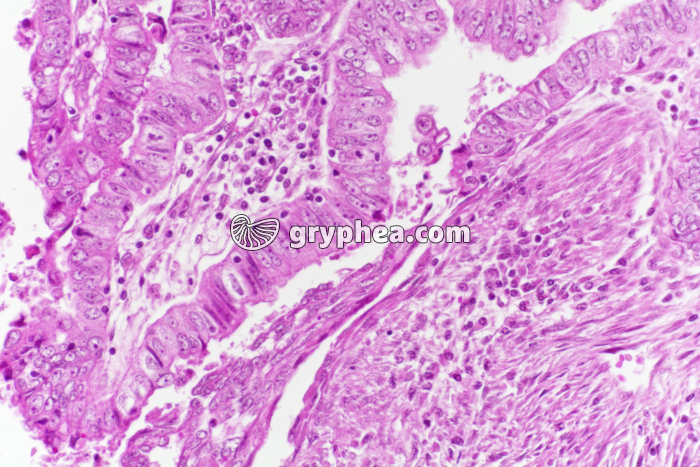 Cancer de la vésicule biliaire x100 - gryphea.org